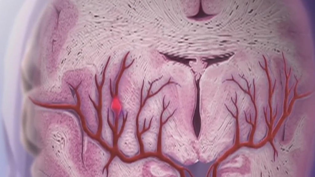 Knowing the signs of a stroke can save lives — McDonough Community news
